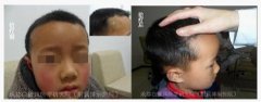 郑某某,男,6岁,局限型白癜风