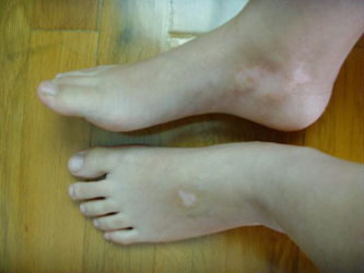 白癜风存在哪些潜在危害