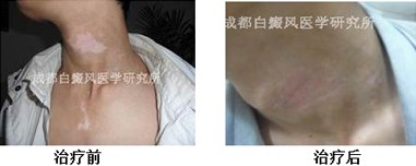 白癜风为什么越早治疗越好