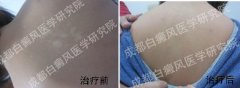 美丽继续,生活继续,我的白癜风