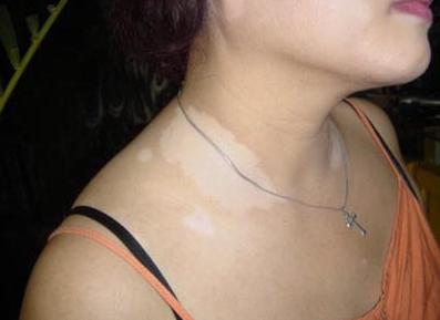 白癜风初期发病症状有哪些?