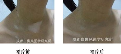 如何有效治疗儿童白癜风