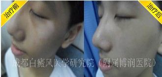 局限型白癜风能不能治好