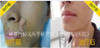 如何提高白癜风的治疗效果
