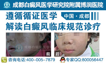 µäÐ͵İ×ñ°·çÖ¢×´ÓÐÄÄЩ±íÏÖ